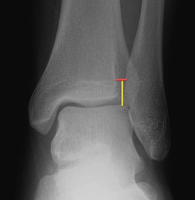 tibial plafond