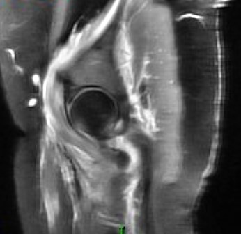 Figure 3 for case Dermatomyositis