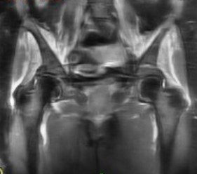 Figure 4 for case Dermatomyositis