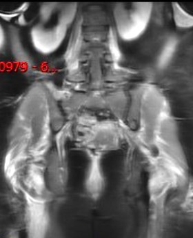 Figure 5 for case Dermatomyositis