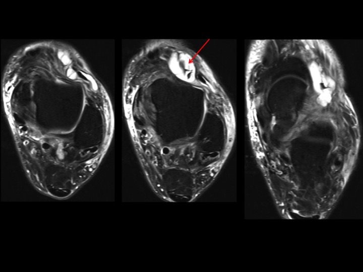 Figure 3 for case bursa