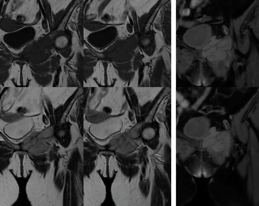 Figure 2 for case Sarcoma