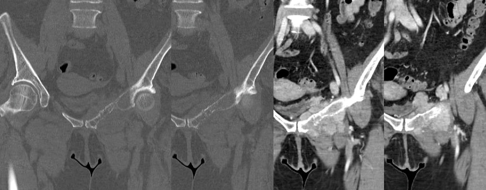 Figure 3 for case Sarcoma
