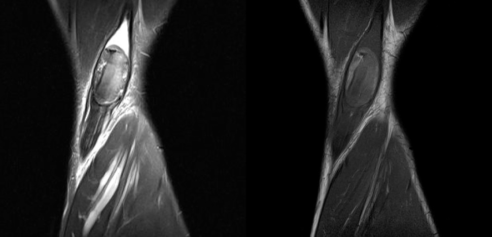 Figure 5 for case Hematoma