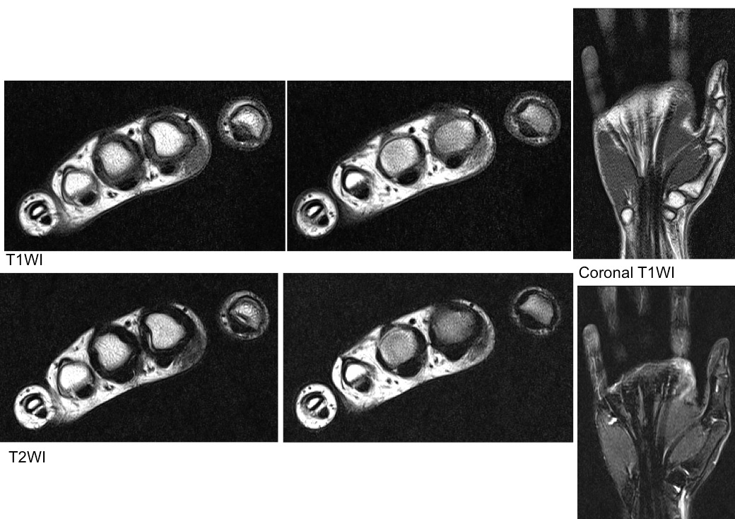 Figure 2 for case Fibromatosis