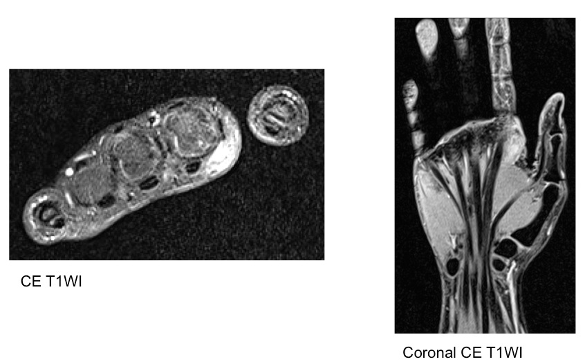 Figure 3 for case Fibromatosis