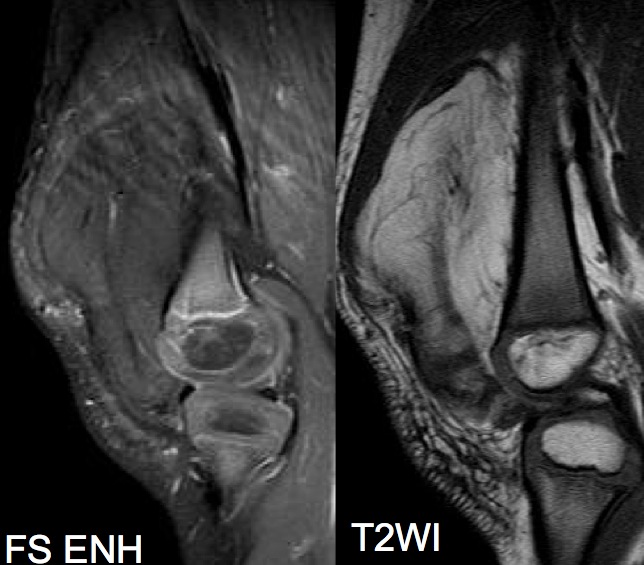 Figure 2 for case Lipofibromatosis