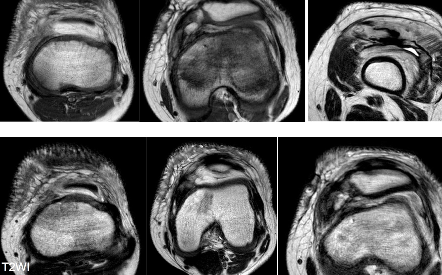 Figure 3 for case Lipofibromatosis