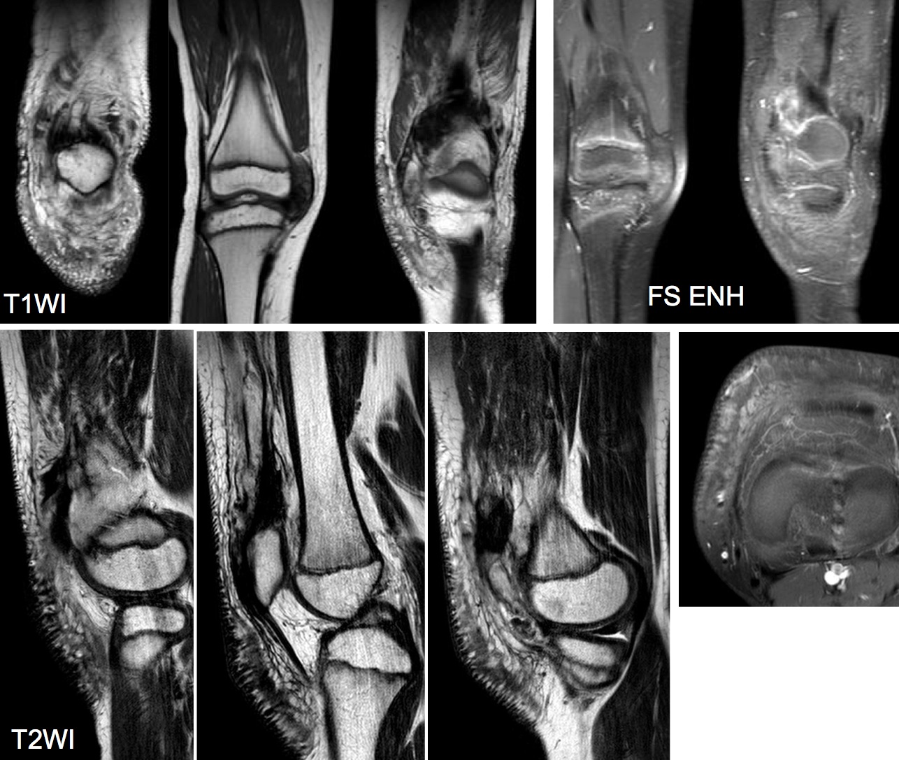 Figure 4 for case Lipofibromatosis