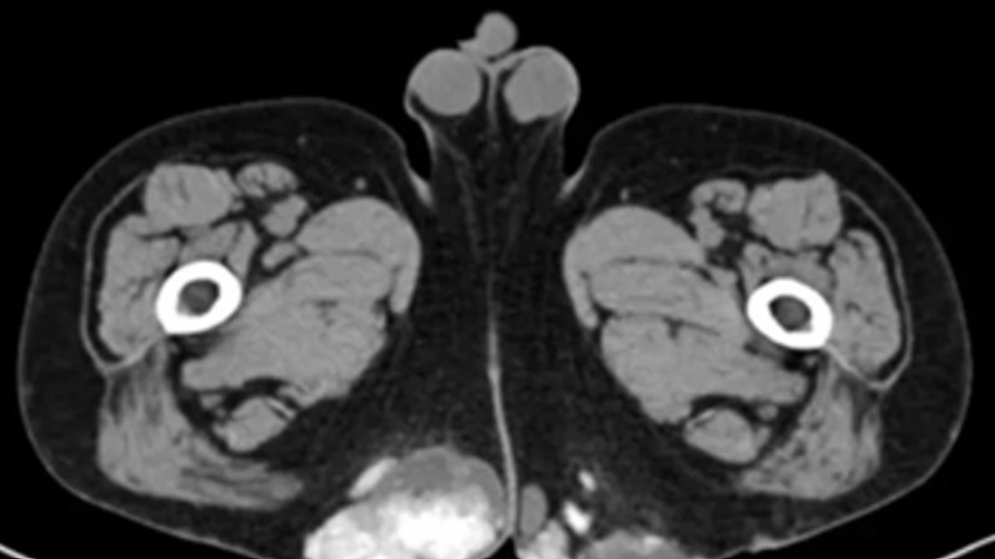 Figure 2 for case Gout
